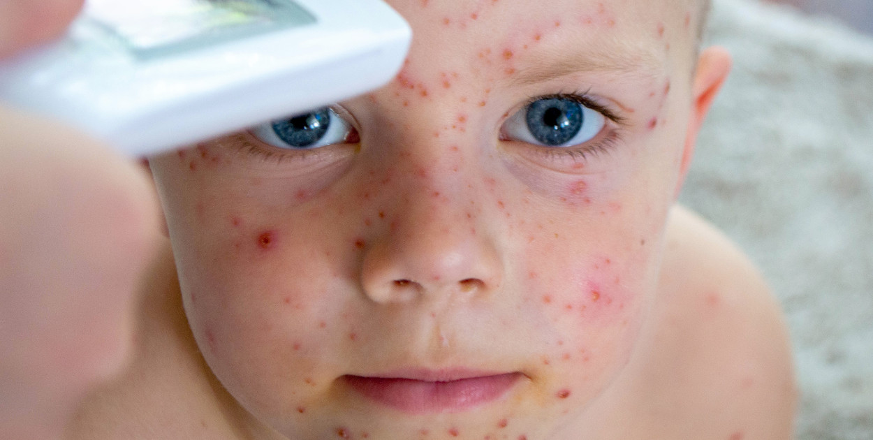 Na Podkarpaciu stwierdzono ognisko odry